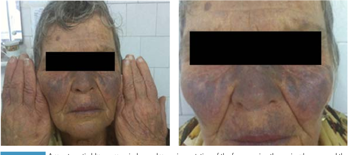 Blue-Gray Discoloration of Skin: A Side Effect of Amiodarone