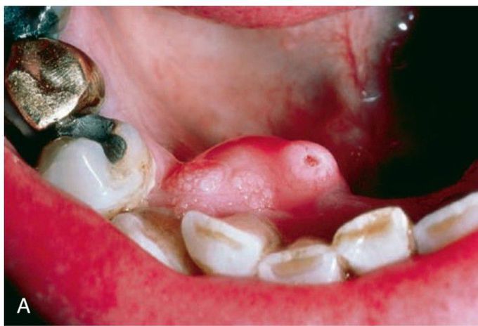 Ameloblastoma