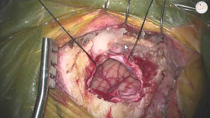Microsurgical Forceps Rhizotomy for Questionable Venous or no Vascular Compression