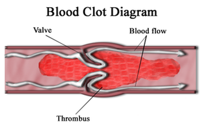 Treatment of thrombus