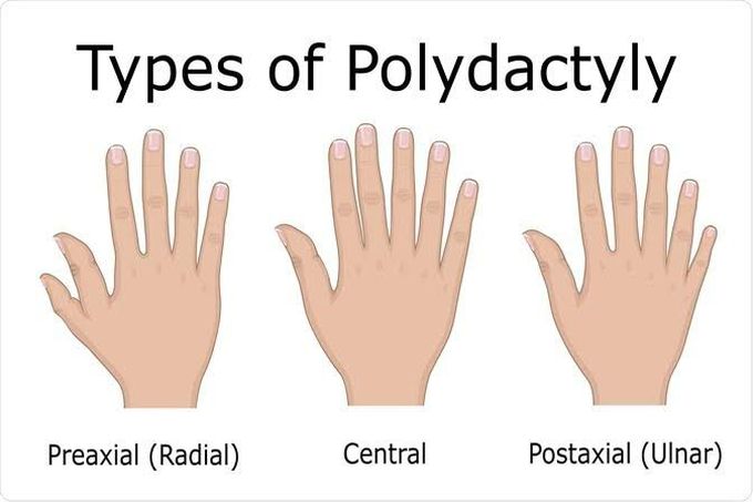 Quick guide to types of polydactyly