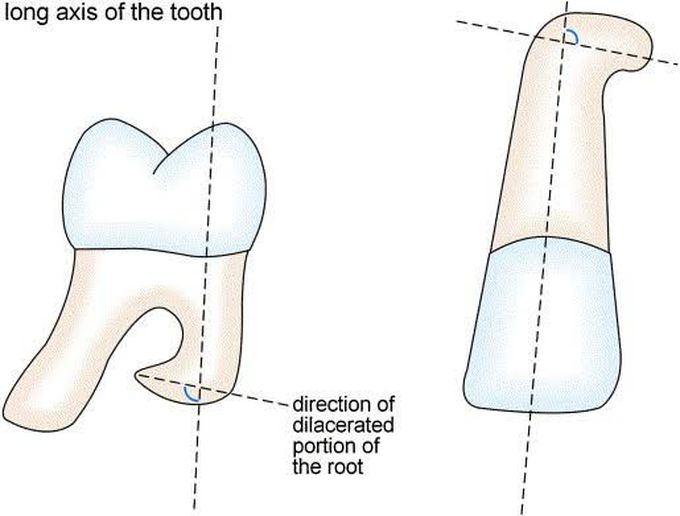 Dilaceration