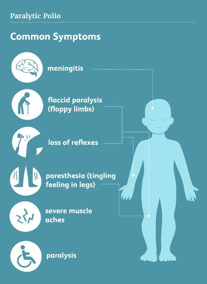 Symptoms of Poliomyelitis (polio)