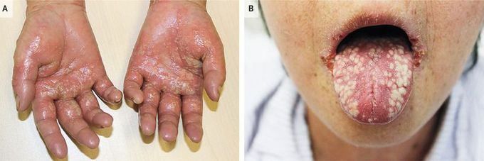 Acute Generalized Exanthematous Pustulosis