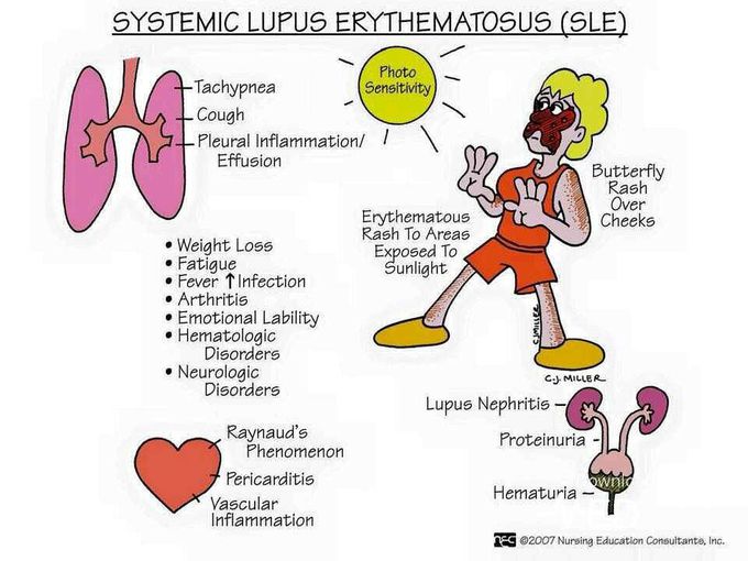 SLE Symptomes