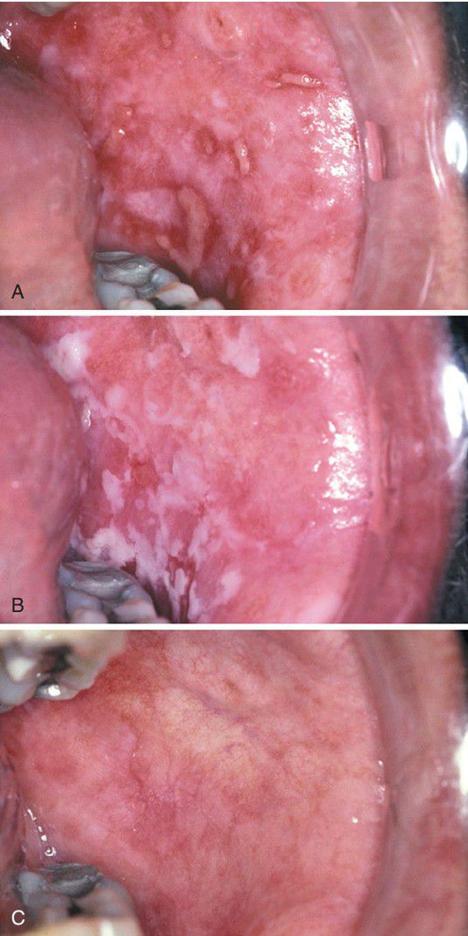 Lichen Planus.