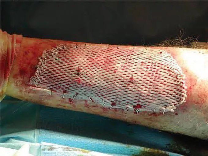 Skin grafting