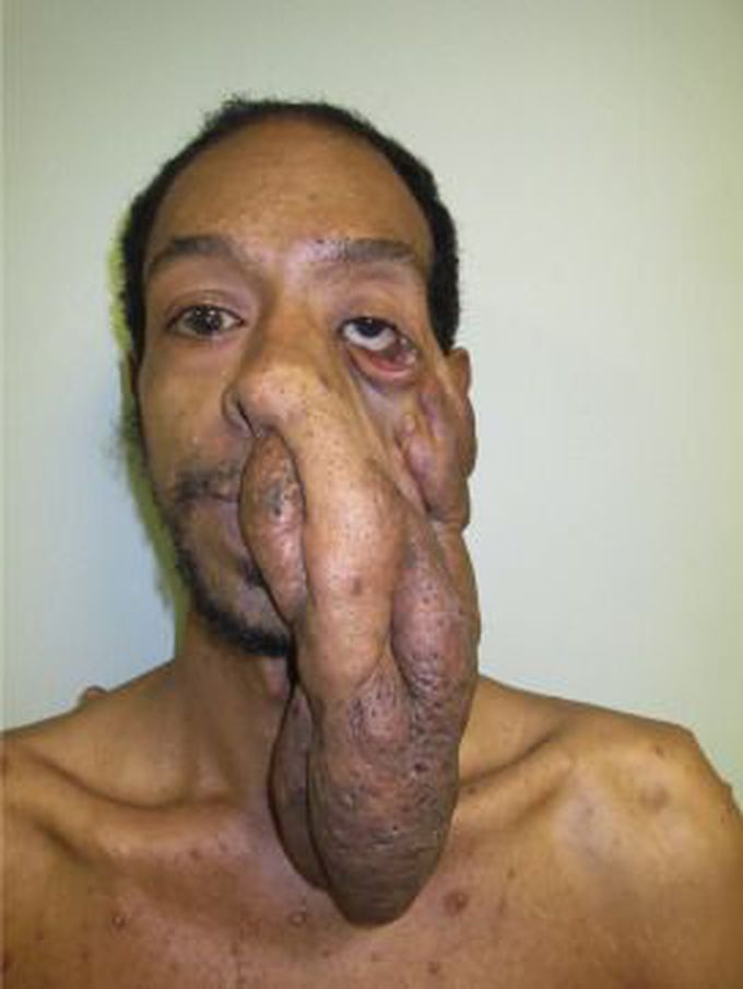 Neurofibromatosis Type 1