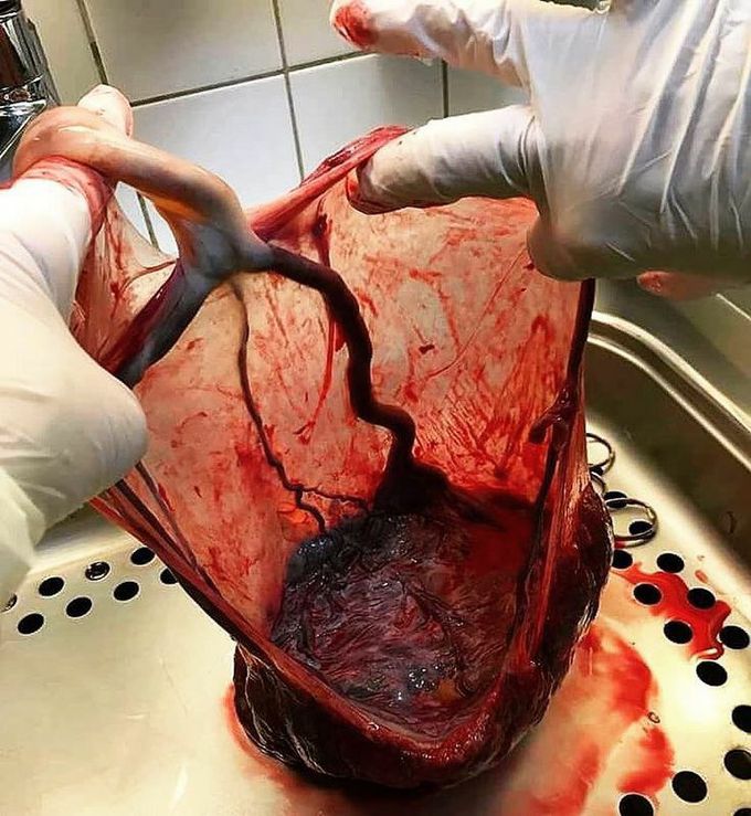 A BEAUTIFUL VIEW OF PLACENTA