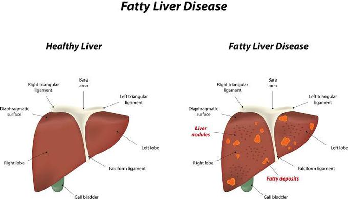 Normal Vs Fatty Liver