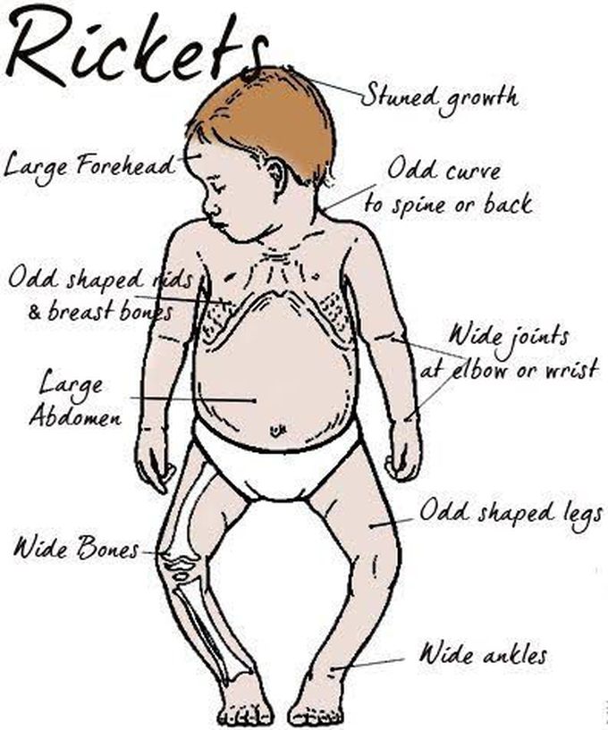 Signs and symptoms of Rickets