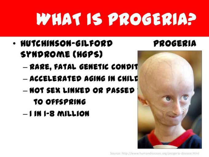 Rare genetic disorder—PROGERIA