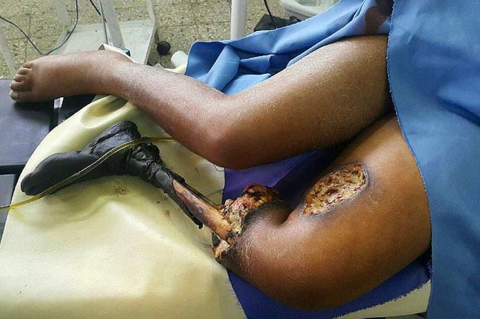 Gangrenous foot