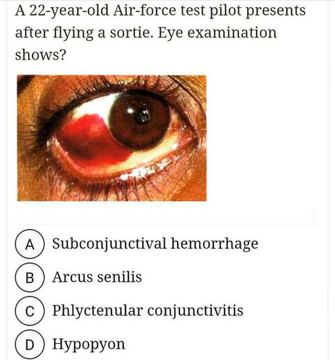 Identify the eye condition