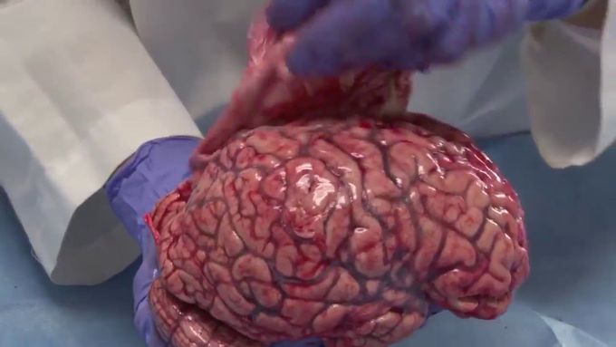 What’s Inside a Fresh Human Brain
