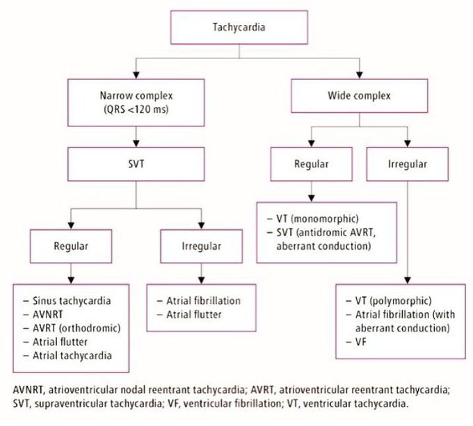 Tachycardia