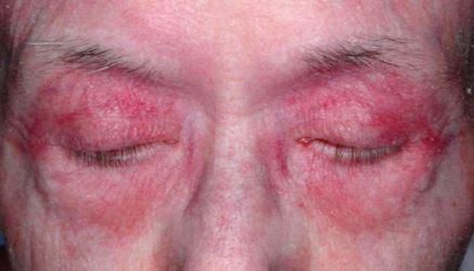 What's the name of this sign in dermatomyositis??