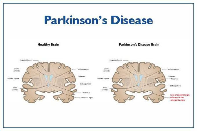 Parkinson's disease