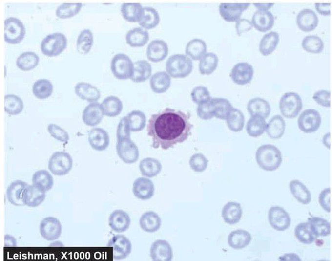 Hairy cell leukaemia