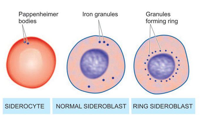 Siderocyte and Sideroblast