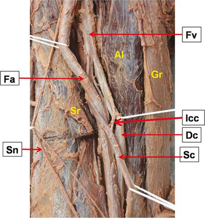 Photograph of the femoral triangle showing interconnecting channel connecting duplicated femoral vein (Fv); Fa — femoral artery; Sn — saphenous nerve; Dc — deep component; Sc — superficial component; Icc — inter connecting channel; Al — adductor longus; Sr — sartorius; Gr — gracilis.