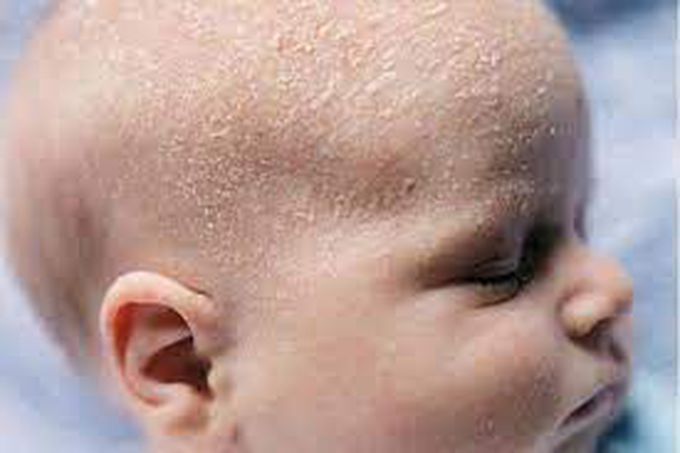 Cradle Cap