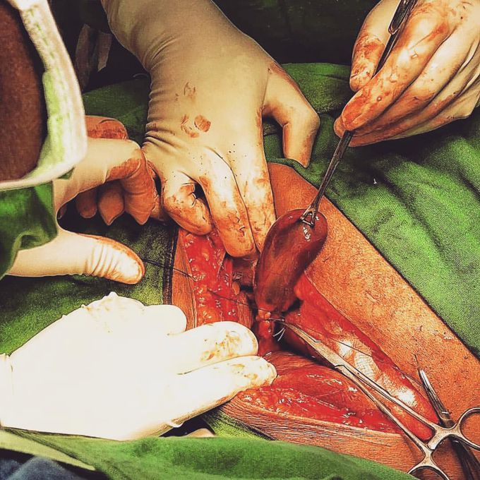 Which organ is being removed? Read below👇🏻 