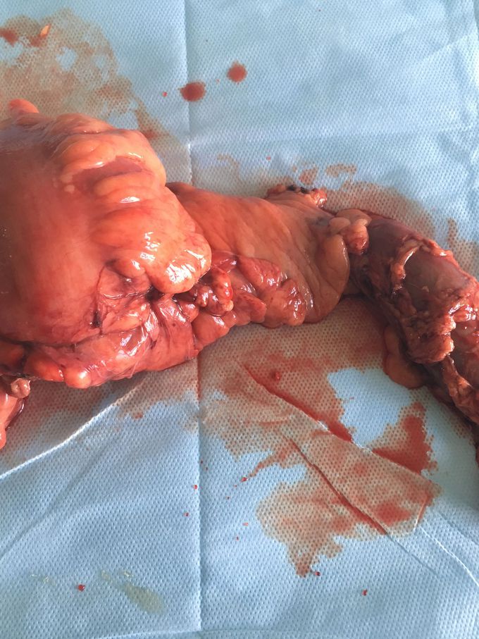 Left hemycolectomy...