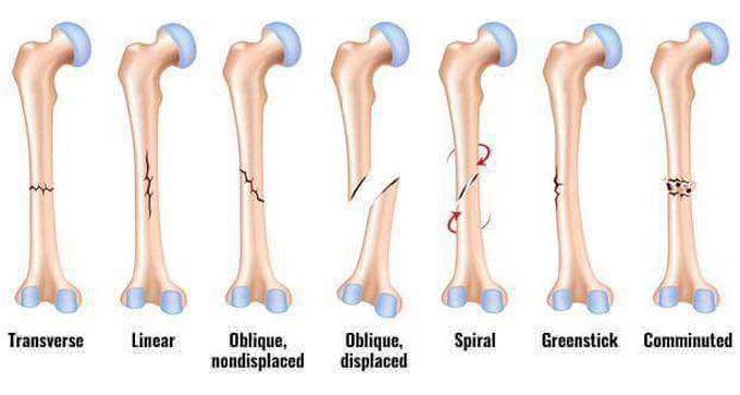 Types of BONE FRACTURE -