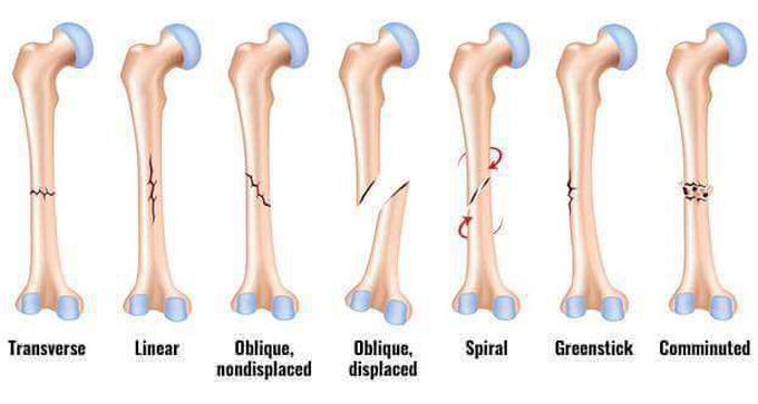 Types of BONE FRACTURE - - MEDizzy