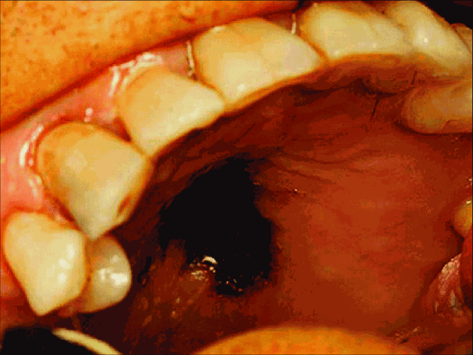 Mucormycosis of Hard Palate