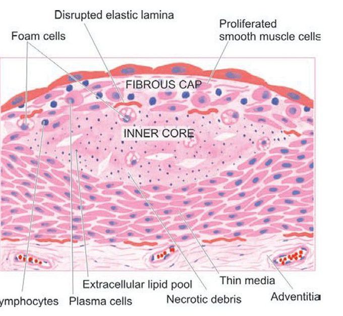 Atheroma