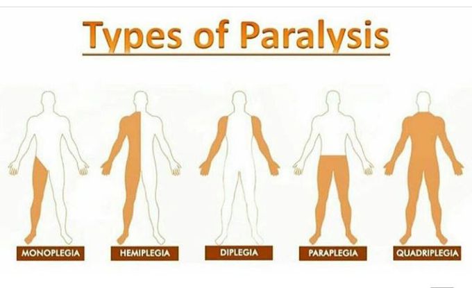 Which is the most common paralysis ?