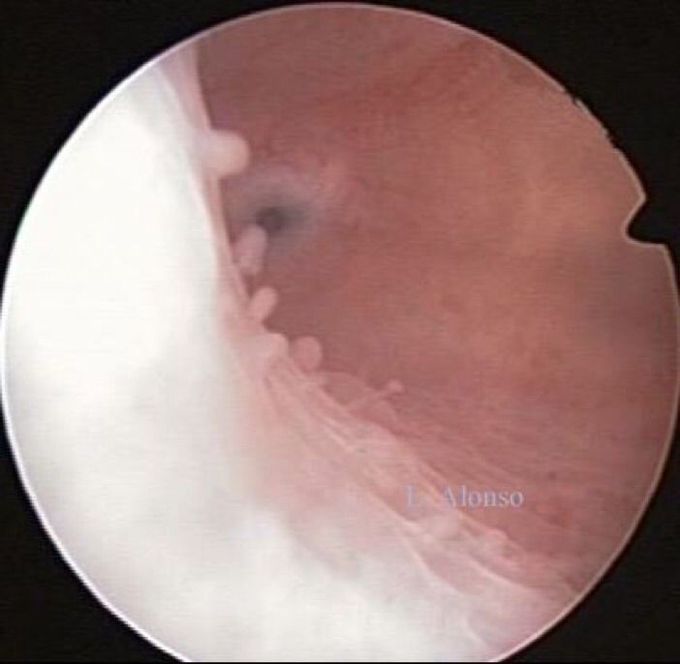 Hysteroscopy