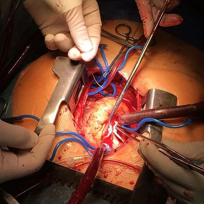 Valve replacement