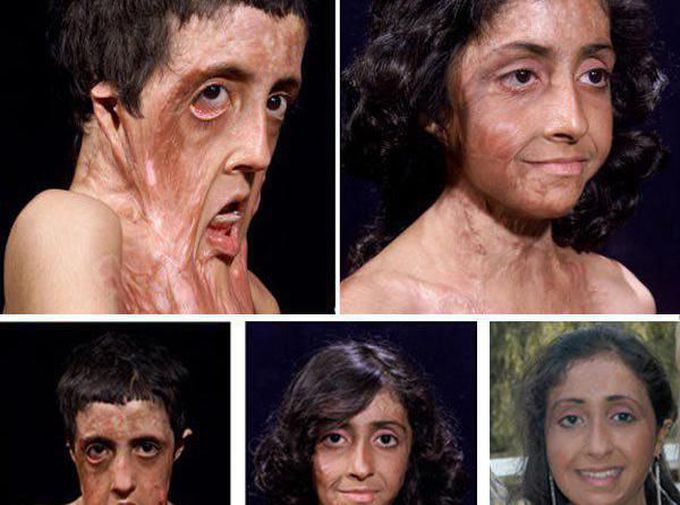 Restoring health and beauty to a burnt child. 💓❤