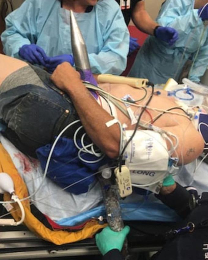 Case of an Idaho man who was impaled by a 40-pound spear! 