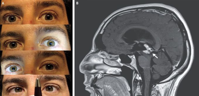 Pupillary Light–Near Dissociation