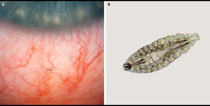 External Ophthalmomyiasis Due to Oestrus ovis