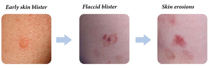 Symptoms of pemphigus vulgaris