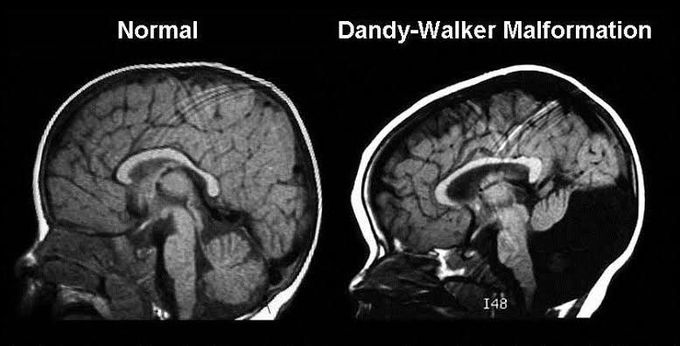 Dandy walker malformation