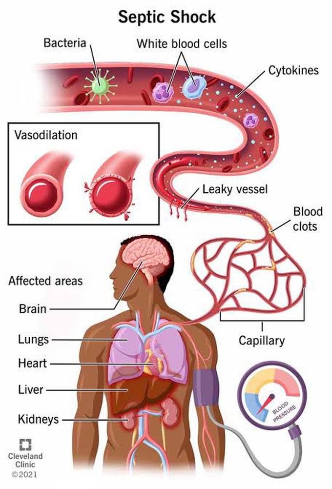 Septic Shock MEDizzy
