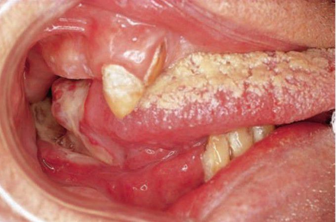 Advanced squamous cell carcinoma of tongue