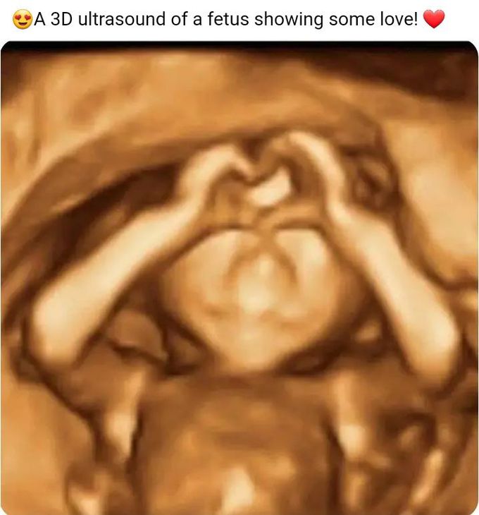 A 3D Ultrasound of a fetus showing some love😍