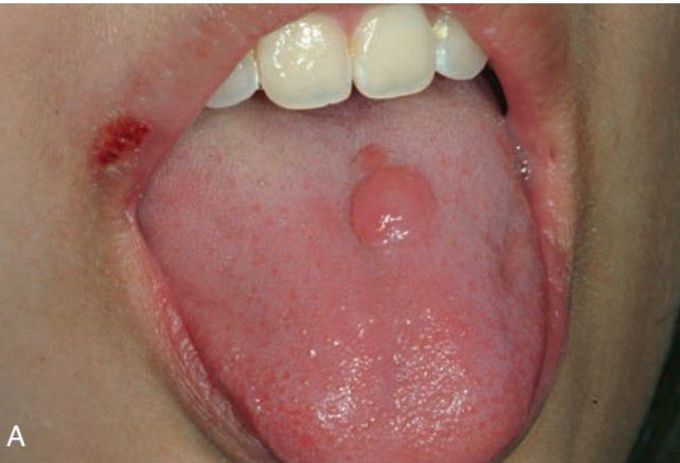 Lymphoma of tongue