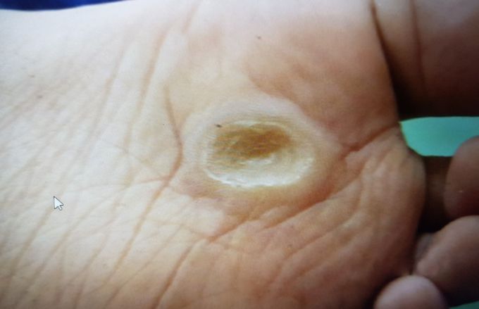 Hyperkeratosis ?