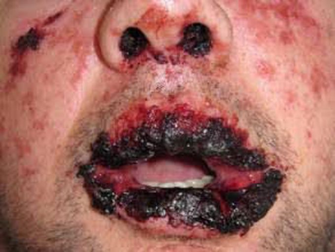 Stenvenjohonson Syndrome