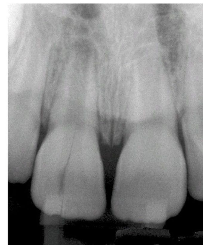 Vertical root fracture