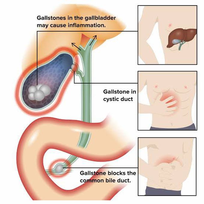 Cholecystitis