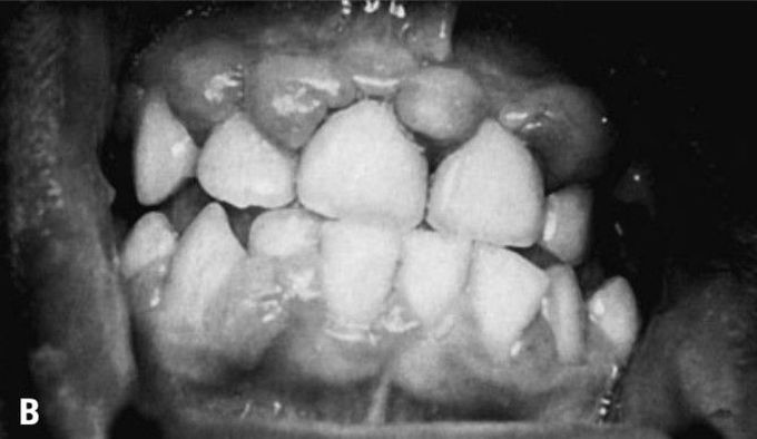 Fibrosis of gingiva